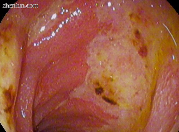 Duodenal ulcer A2 stage, acute duodenal mucosal lesion(ADML)