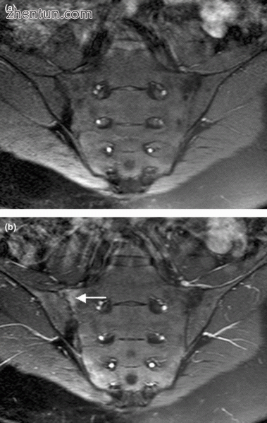 Magnetic resonance images of sacroiliac joints. Shown are T.gif