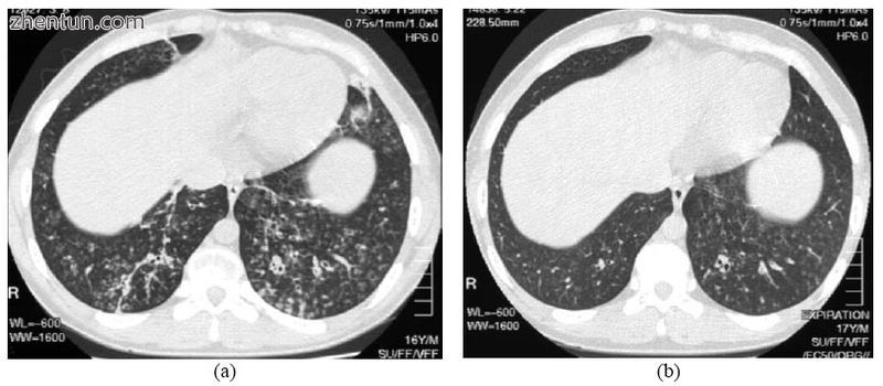 High resolution computed tomography (HRCT) images of the lower chest in a 16-year-old boy initially  ...