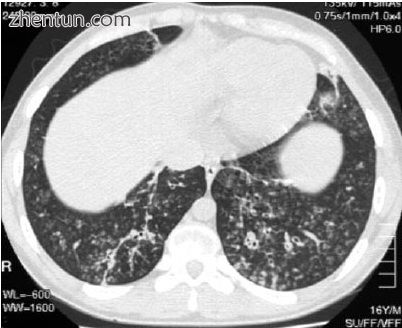 High resolution computed tomography images of the lower chest in a 16-year-old boy with diffuse panb ...