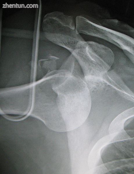 An inferior dislocation of the shoulder after an automobile accident. Note how the humerus is abduct ...