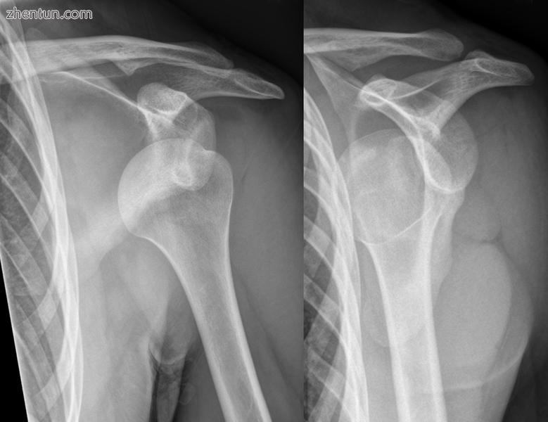 Anterior dislocation of the left shoulder.