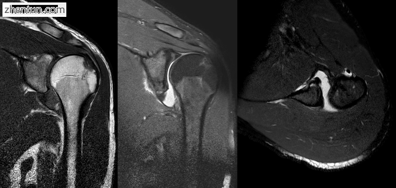 MRI of shoulder after dislocation with Hill-Sachs lesion and labral Bankart's lesion.