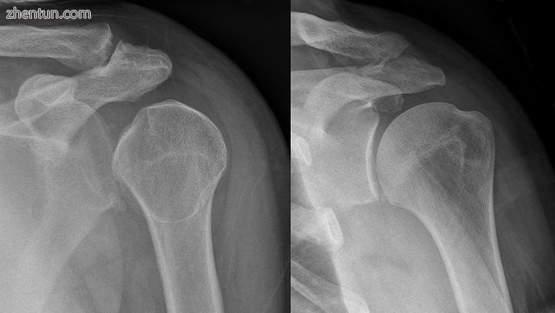 Lightbulb sign indicative of posterior shoulder dislocation shown on the left. On the right, the sam ...