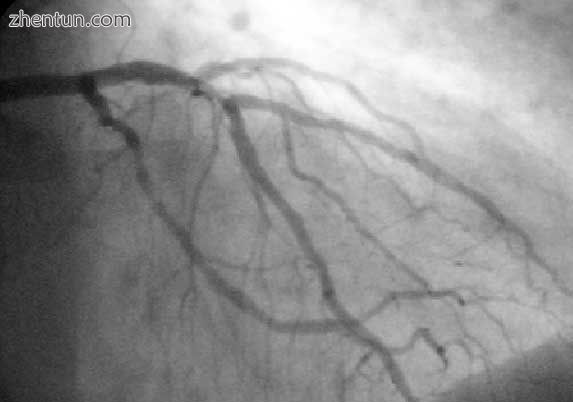 A coronary angiogram (an X-ray with radiocontrast in the coronary arteries) that shows the left coro ...