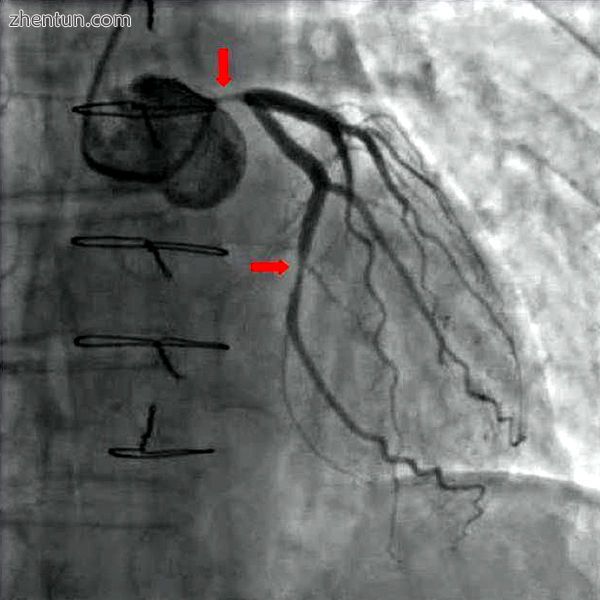 Coronary angiography of a critical sub-occlusion of the common trunk of the left coronary artery and ...