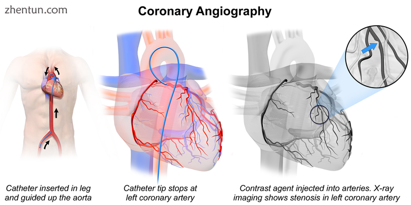 Coronary Angiography.