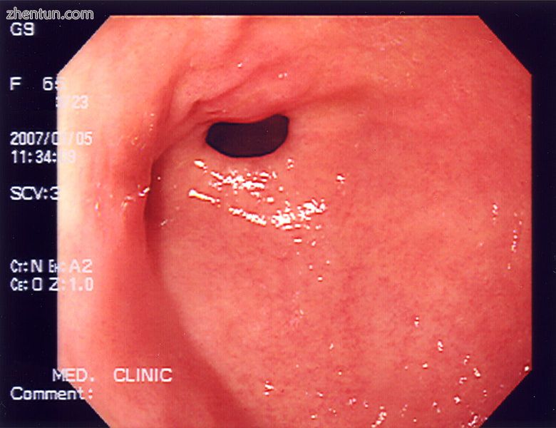 An endoscopy of a normal stomach of a healthy 65-year-old woman.