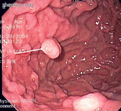 Endoscopic image of human fundic gland polyposis.