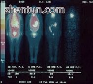 Sequence of total-body scintigraphies of a woman after intravenous injection of iodine-123 demonstra ...
