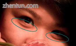 Eye bags – minor periorbital puffiness usually detectable below the eyes only.