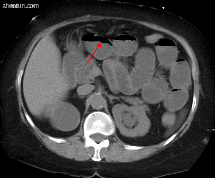 A small bowel obstruction as seen on CT