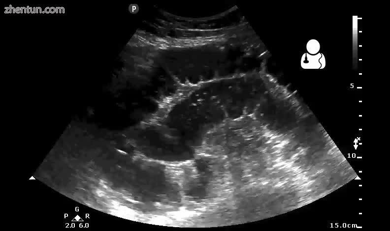 Small bowel obstruction on ultrasound.[14]3.jpg