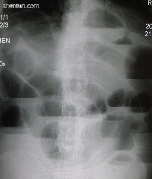 Upright abdominal X-ray demonstrating a small bowel obstruction. Note multiple air fluid levels.