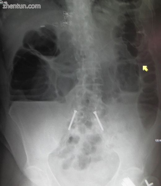 Upright abdominal X-ray of a person with a large bowel obstruction showing multiple air fluid levels ...