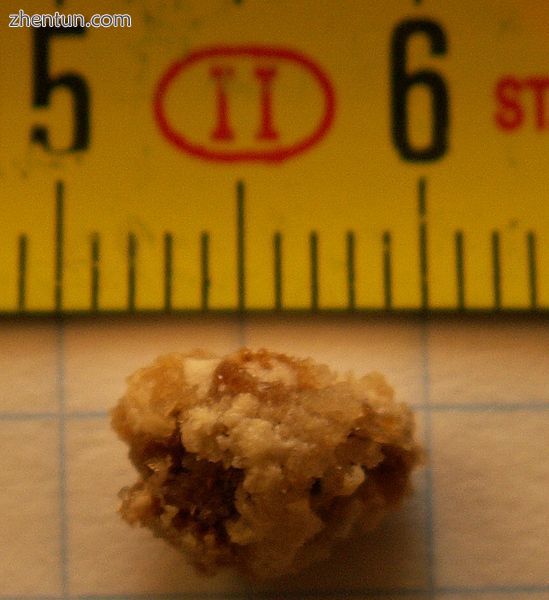A kidney stone, 8 millimeters (0.3 in) in diameter