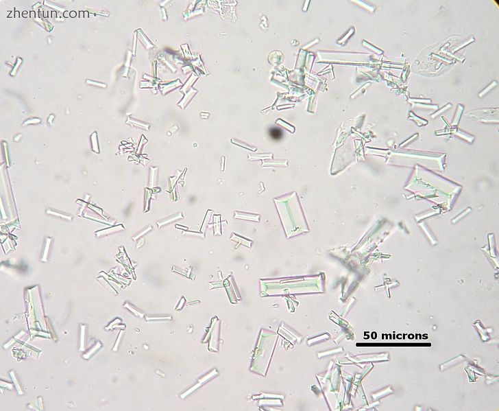 Struvite crystals found on microscopic examination of the urine