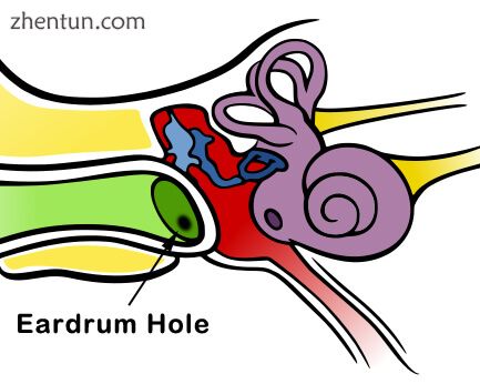 Hole in the Eardrum