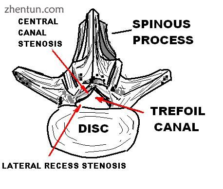 Spinal stenosis.JPG