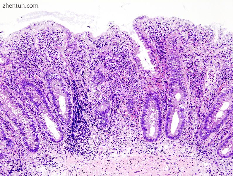 Biopsy sample (H&E stain) that demonstrates marked lymphocytic infiltration (blue/purple) of the i ...