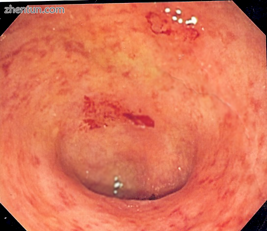 Endoscopic image of a colon affected by ulcerative colitis. The internal surface of the colon is blo ...