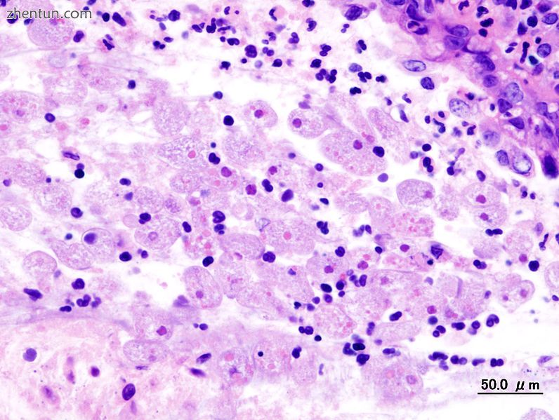 Amoebae in a colon biopsy from a case of amoebic dysentery.