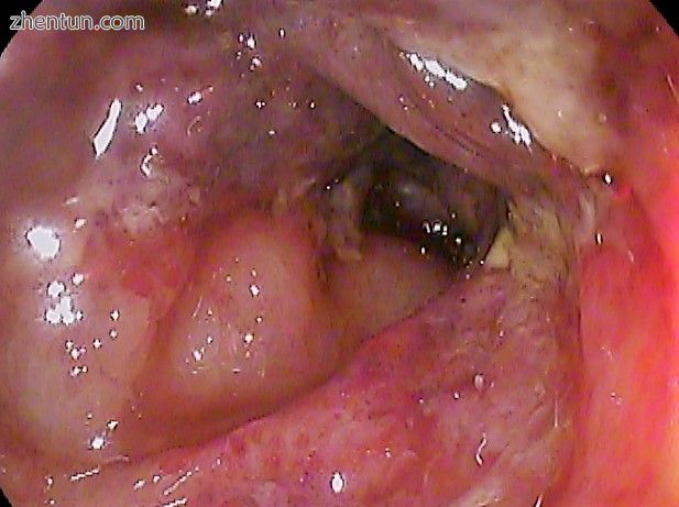 Ischemic colitis, transverse colon, 82 y. o. female