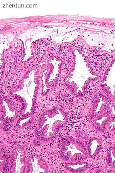 Micrograph showing changes seen in ischemic colitis. H&E stain.