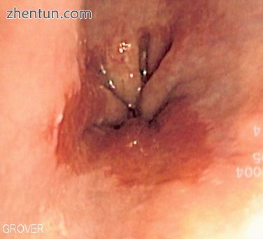 Endoscopic image of Barrett's esophagus, which is the area of red mucosa projecting like a tongue. B ...