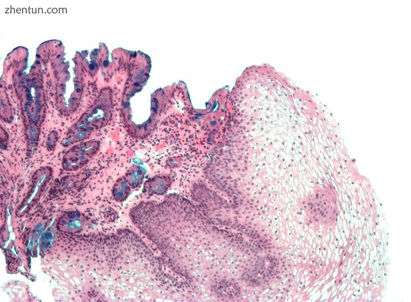 Micrograph of Barrett's esophagus (left of image) and normal stratified squamous epithelium (right o ...