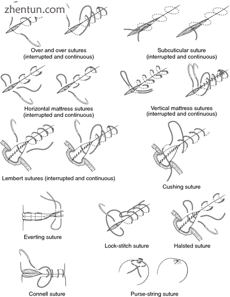 Various types of sutures. From Dorland's, 2000..png