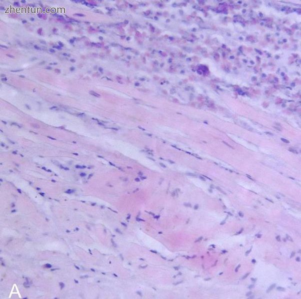 Endomyocardial biopsy specimen with extensive eosinophilic infiltrate involving .jpg