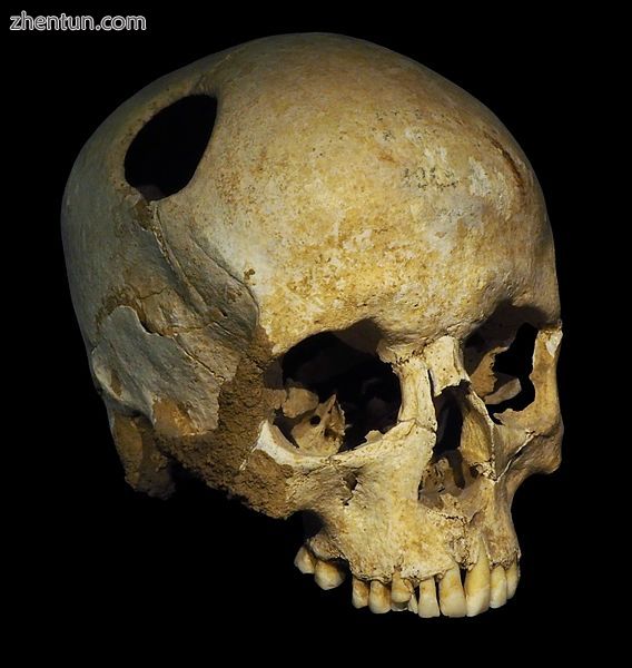 The perimeter of the hole in this trepanated Neolithic skull is rounded off by i.jpg