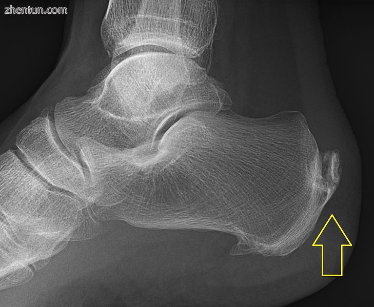 Calcification deposits forming an enthesophyte within the Achilles tendon at its.jpg