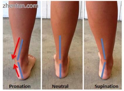 Demonstration of the right foot in pronation, neutral and supinated subtalar joi.png