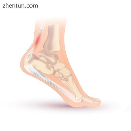 Drawing of Achilles tendonitis with the affected part highlighted in red.png