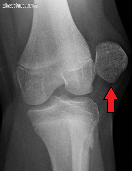 X-ray showing a patellar dislocation, with the patella out to the side..png
