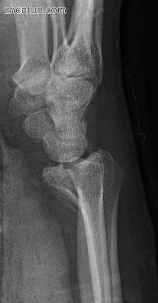 Lateral projectional radiograph of the same fracture..jpg