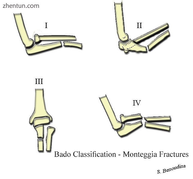 Bado Classification - Monteggia Fractures.jpg