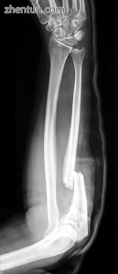 X-ray of Monteggia fracture of right forearm.jpg