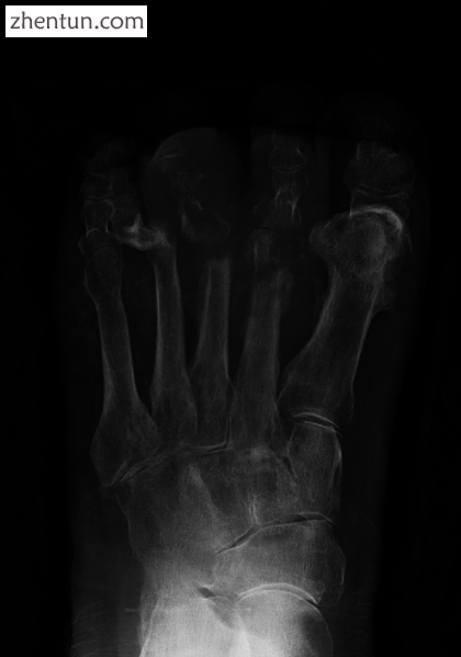 Extensive osteomyelitis of the forefoot.png