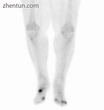 Osteomyelitis in both feet as seen on bone scan.png