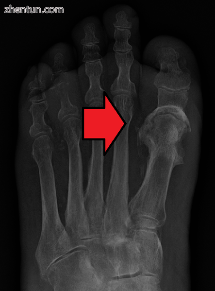 Osteomyelitis of the 1st toe.png