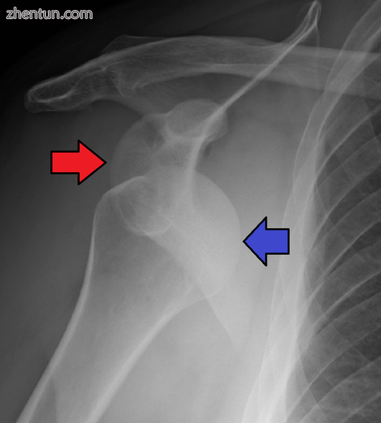 Anterior dislocation of the right shoulder. AP X ray.png