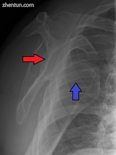 Anterior dislocation of the right shoulder. Y view X ray..png