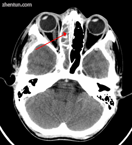 A computed tomograph showing infection of the ethmoid sinus.png