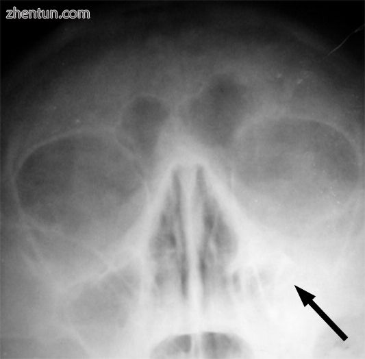 Left-sided maxillary sinusitis marked by an arrow. Note the lack of the air tran.jpg