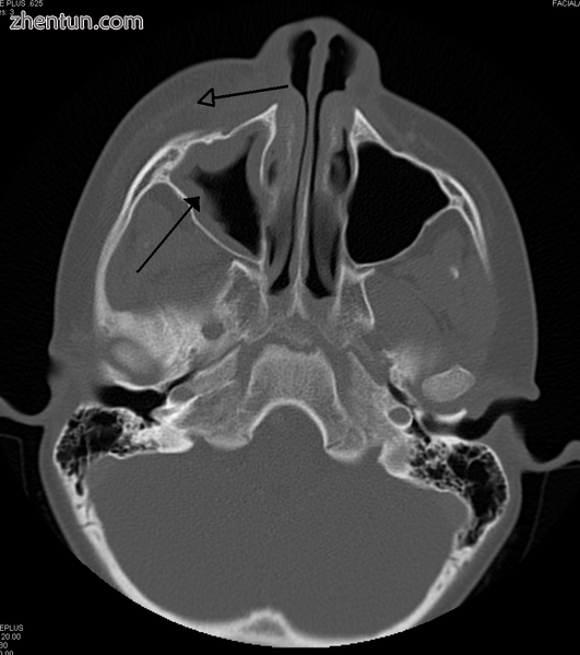 Maxillary sinusitis caused by a dental infection associated with periorbital cel.png