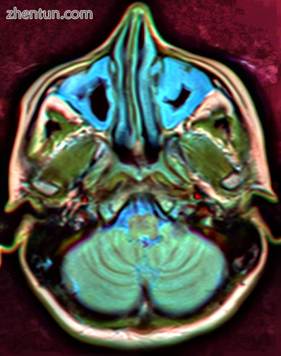MRI image showing sinusitis. Edema and mucosal thickening appears in both maxill.png