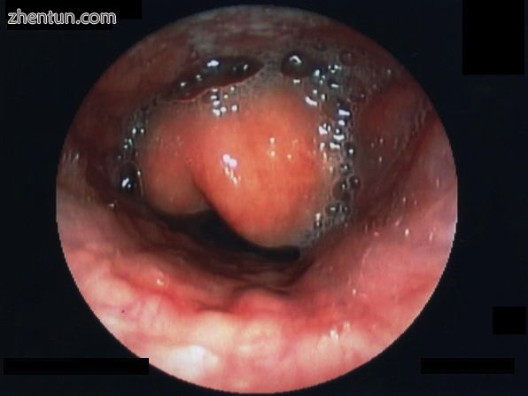 Swollen epiglottis in laryngoscopy.jpg